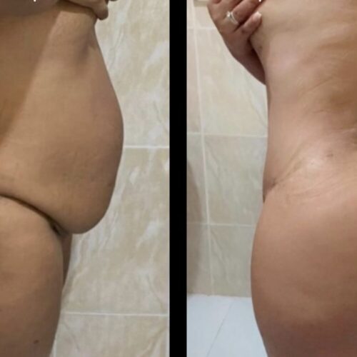 Liposuction Raffle by Dr Nathaly Bello