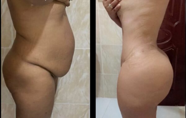 Liposuction Raffle by Dr Nathaly Bello