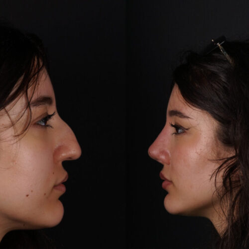 Rinoplastia Completa - Dr. Martinez