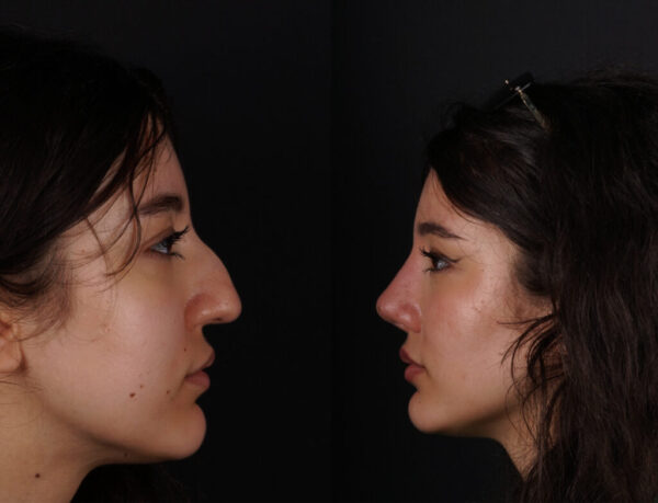 Rinoplastia Completa - Dr. Martinez